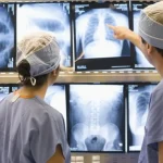 Novo protocolo no SUS visa ampliar acesso à cirurgia torácica no tratamento do câncer de pulmão